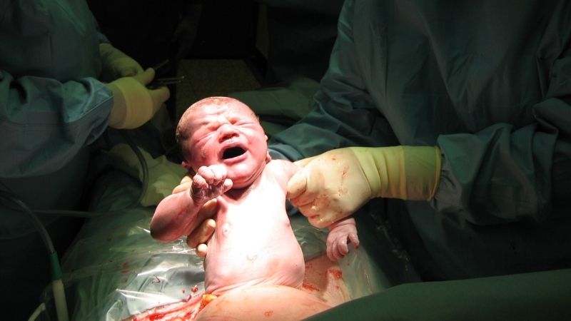 Caesarean Section