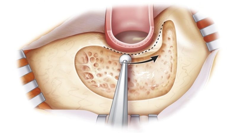 Mastoidectomy