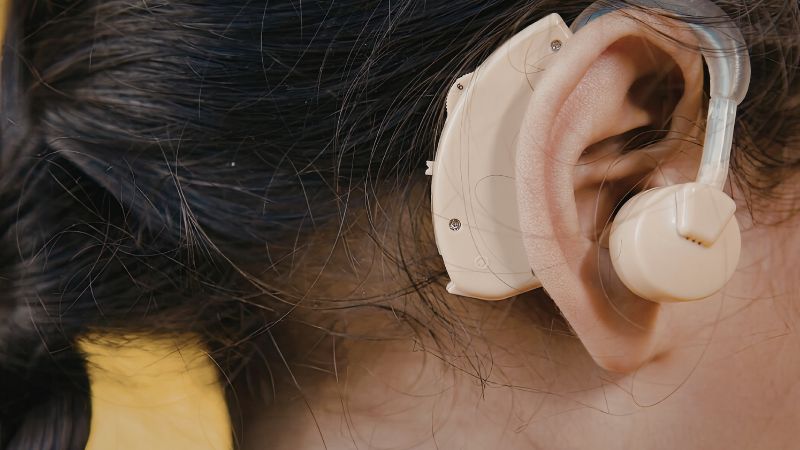 Cochlear Implant Surgery